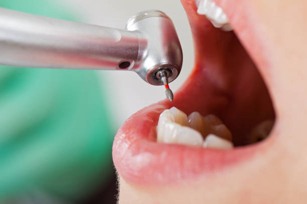Best Lost Filling or Crown Replacement in Los Alamos, NM